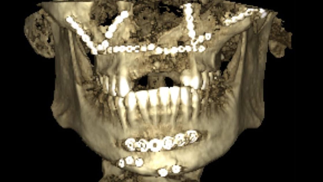 Facial Fracture Image