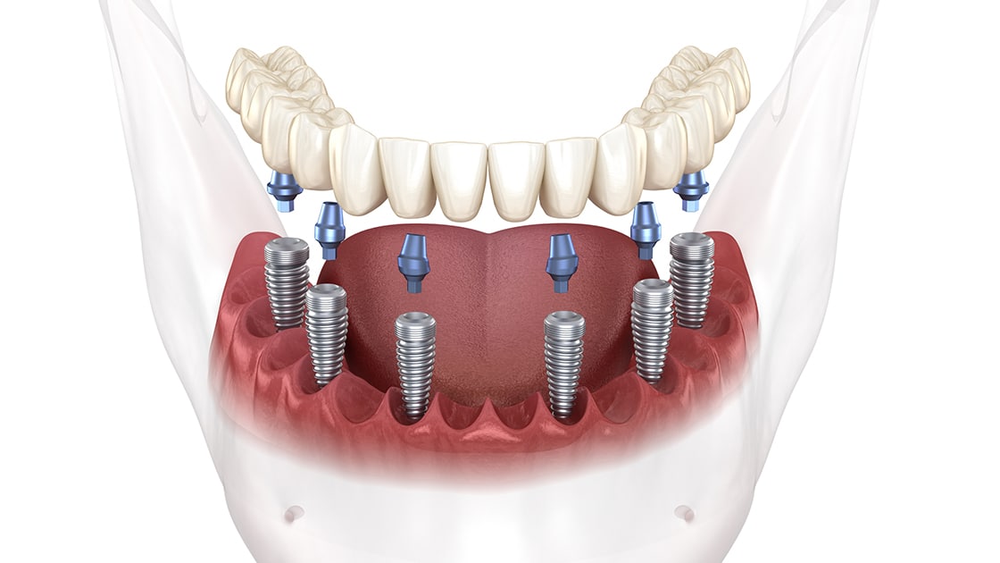 Implant Supported Dentures Decorative Photo