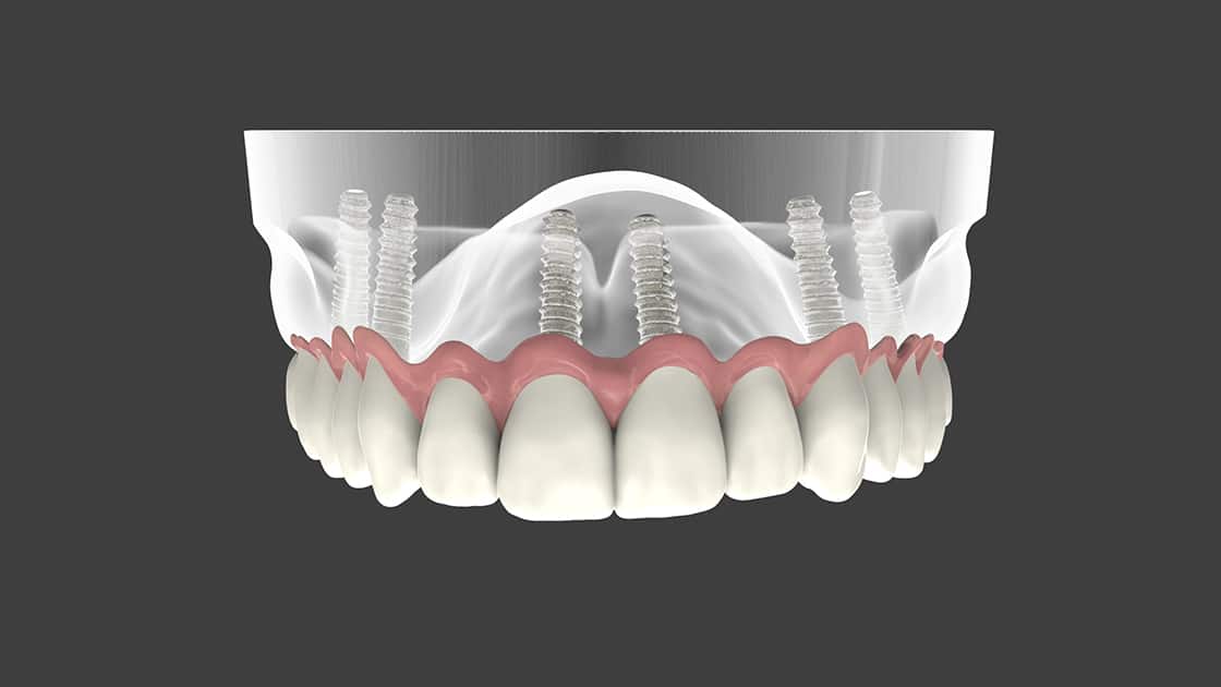 Dental Implants