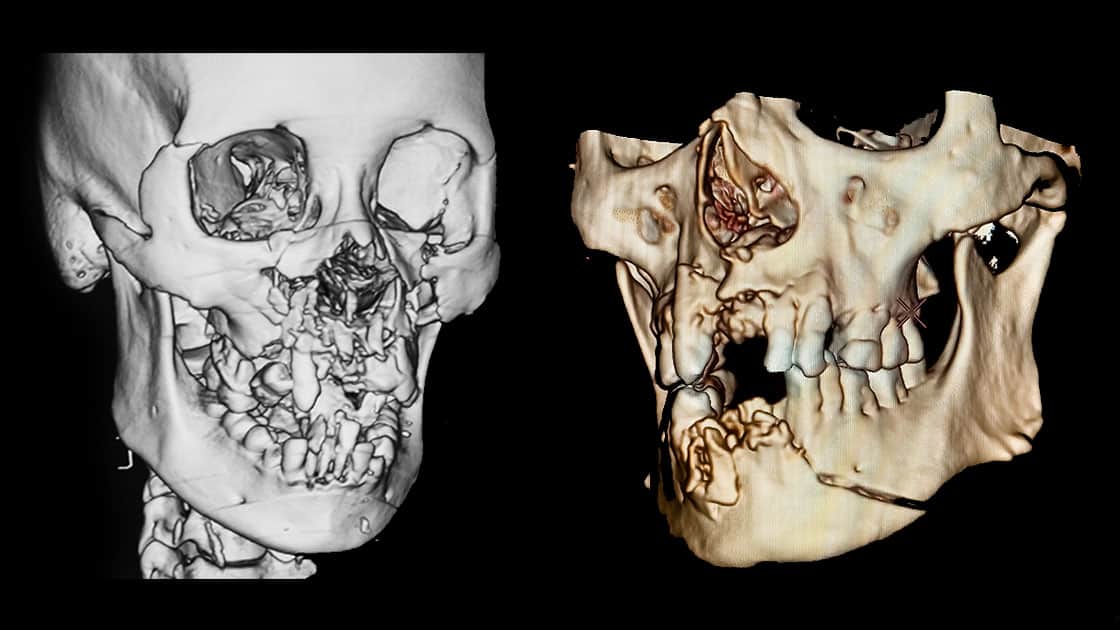 Facial Trauma Example Photo