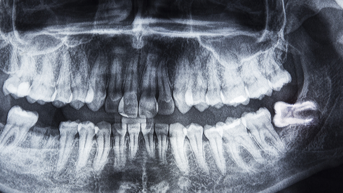 Wisdom Teeth Decorative Image